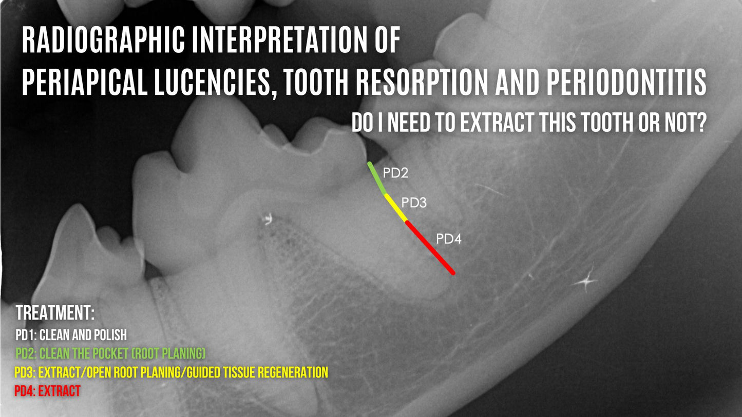 Radiographic and Clinical Interpretation of Periodontitis - Should I extract this tooth or not?